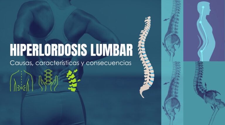 HIPERLORDOSIS LUMBAR: CAUSA, CARACTERÍSTICAS Y CONSECUENCIAS